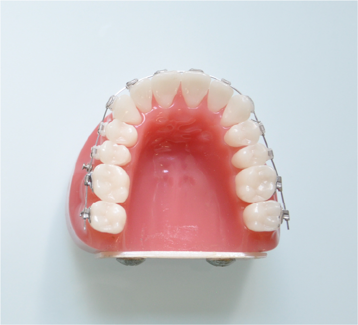 表側矯正イメージ